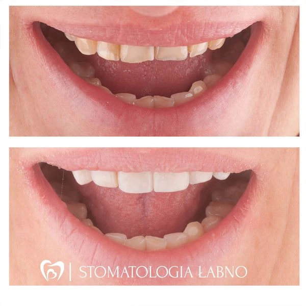 Bonding w Stomatologia Łabno