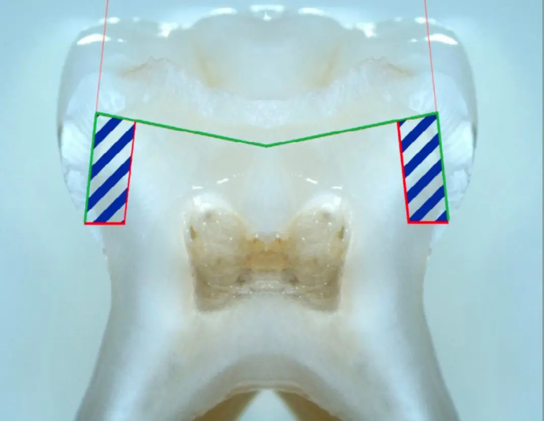 Comparison of horizontal and vertical methods of tooth preparation for a prosthetic crown