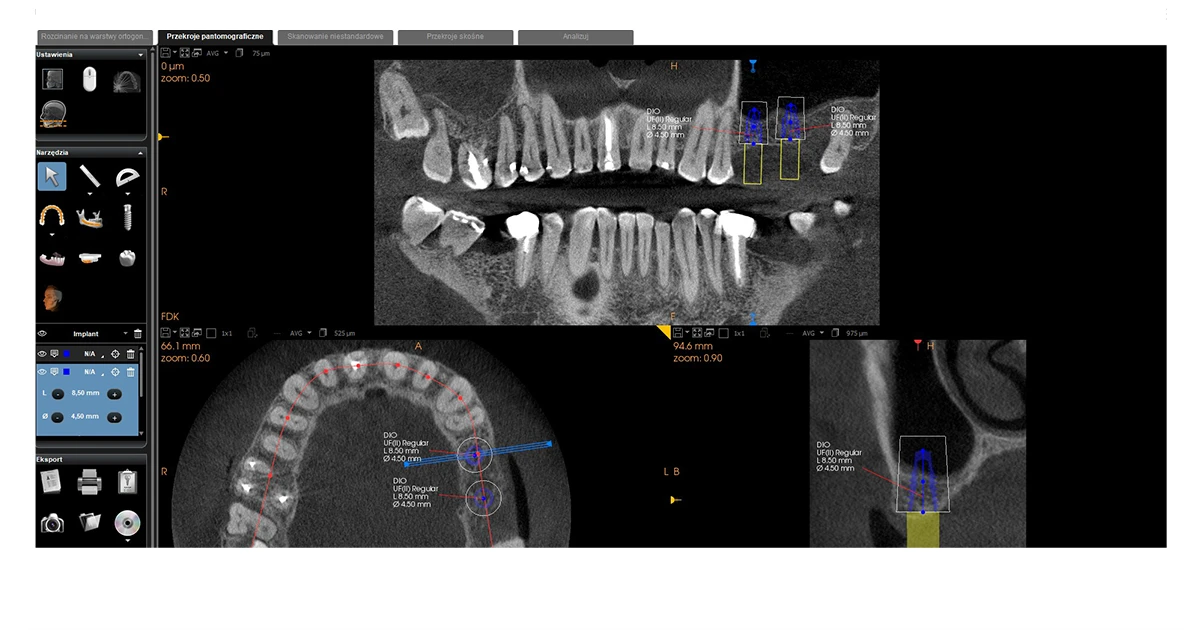 Przypadek implantacji